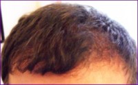 After 2nd hair restoration